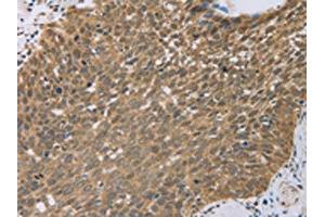 The image on the left is immunohistochemistry of paraffin-embedded Human cervical cancer tissue using ABIN7130557(PCP4 Antibody) at dilution 1/50, on the right is treated with fusion protein. (PCP4 抗体)