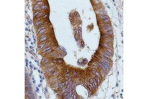 Immunohistochemical analysis of Alpha-tubulin staining in human colon cancer formalin fixed paraffin embedded tissue section. (alpha Tubulin 抗体)