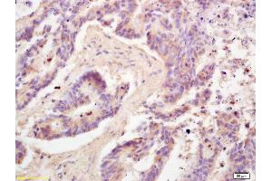 Formalin-fixed and paraffin embedded human colon carcinoma labeled with Rabbit Anti Adiponectin Polyclonal Antibody, Unconjugated (ABIN669051) at 1:200 followed by conjugation to the secondary antibody and DAB staining (ADIPOQ 抗体  (AA 151-244))