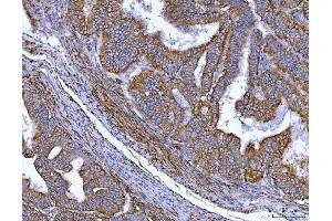 IHC analysis of MIM/MTSS1 using anti-MIM/MTSS1 antibody (ABIN7600276). (MTSS1 抗体  (AA 17-692))