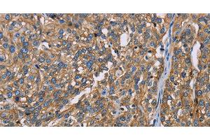 Immunohistochemistry of paraffin-embedded Human esophagus cancer using BSG Polyclonal Antibody at dilution of 1:60 (CD147 抗体)