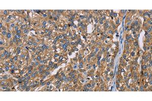 Immunohistochemistry of paraffin-embedded Human esophagus cancer using BSG Polyclonal Antibody at dilution of 1:60 (CD147 抗体)