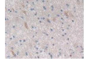 IHC-P analysis of Human Glioma Tissue, with DAB staining. (CTRB1 抗体  (AA 34-261))