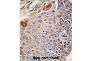 Formalin-fixed and paraffin-embedded human lung carcinoma reacted with RMND5B antibody (C-term), which was peroxidase-conjugated to the secondary antibody, followed by DAB staining. (RMND5B 抗体  (C-Term))