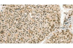 Immunohistochemistry of paraffin-embedded Human liver cancer using ANGPT4 Polyclonal Antibody at dilution of 1:70 (Angiopoietin 4 抗体)