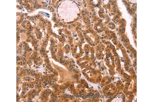 Immunohistochemistry of Human lung cancer using PROS1 Polyclonal Antibody at dilution of 1:40 (PROS1 抗体)