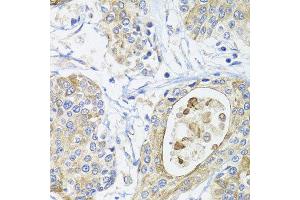 Immunohistochemistry of paraffin-embedded human prostate cancer using GSTA2 antibody at dilution of 1:100 (x40 lens). (GSTa2 抗体)