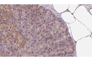 ABIN6273260 at 1/100 staining Human pancreas cancer tissue by IHC-P. (LAPTM4B 抗体  (Internal Region))