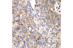 Immunohistochemistry of paraffin-embedded human lung cancer using SPARC antibody (ABIN3022250, ABIN3022251, ABIN1513555 and ABIN6218694) at dilution of 1:100 (40x lens).