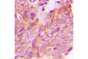 Immunohistochemical analysis of FRK staining in human breast cancer formalin fixed paraffin embedded tissue section. (FRK 抗体  (Center))
