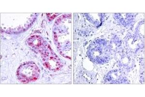 Immunohistochemistry analysis of paraffin-embedded human breast carcinoma, using c-Jun (Phospho-Ser243) Antibody. (C-JUN 抗体  (pSer243))