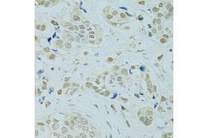 Immunohistochemistry of paraffin-embedded human breast cancer using RCC1 antibody (ABIN5973761) at dilution of 1/100 (40x lens). (RCC1 抗体)