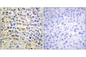 Immunohistochemistry analysis of paraffin-embedded human breast carcinoma tissue, using EGFR (Ab-678) Antibody. (EGFR 抗体  (AA 651-700))