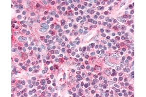 Anti-NR1D1 antibody IHC of human Lymph Node, Hodgkins Lymphoma.