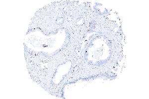 Prostatic adenocarcinoma Gleason 336 with strong MCM3 positivity of few tumor cells (MCM3 抗体)