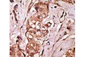 IHC analysis of FFPE human breast carcinoma tissue stained with the LRRK2 antibody (LRRK2 抗体  (AA 931-962))