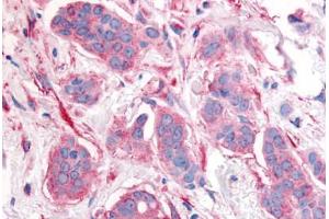 Human Breast Carcinoma, Neoplastic Cells (formalin-fixed, paraffin-embedded) stained with ERBB2 antibody ABIN213613 at 10 ug/ml followed by biotinylated goat anti-rabbit IgG secondary antibody ABIN481713, alkaline phosphatase-streptavidin and chromogen.