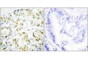 Immunohistochemistry analysis of paraffin-embedded human lung carcinoma tissue, using Ataxin 1 (Ab-776) Antibody. (Ataxin 1 抗体  (AA 742-791))