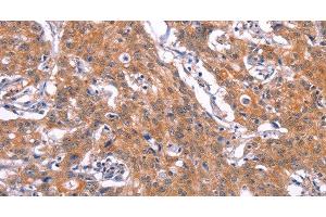 Immunohistochemistry of paraffin-embedded Human gastic cancer using CD269 Polyclonal Antibody at dilution of 1:30 (BCMA 抗体)