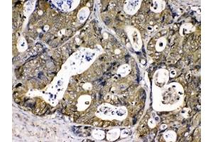IHC testing of FFPE human intestinal cancer tissue with Cyclophilin A antibody at 1ug/ml. (PPIA 抗体)