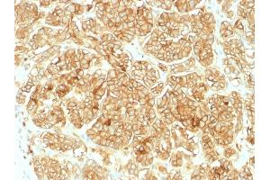Formalin-fixed, paraffin-embedded human Renal Cell Carcinoma stained with EpCAM Rabbit Polyclonal Antibody. (EpCAM 抗体)