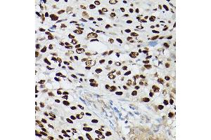 Immunohistochemistry of paraffin-embedded human lung squamous carcinoma tissue using p63 Rabbit mAb (ABIN7271099) at dilution of 1:100 (40x lens). (p63 抗体)