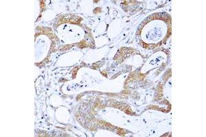 Immunohistochemical analysis of BCR staining in human colon cancer formalin fixed paraffin embedded tissue section. (BCR 抗体  (N-Term))