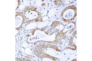 Immunohistochemical analysis of BCR staining in human colon cancer formalin fixed paraffin embedded tissue section.
