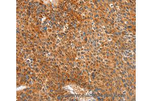 Immunohistochemistry of Human colon cancer using ALDH1A2 Polyclonal Antibody at dilution of 1:30