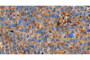 Immunohistochemistry of paraffin-embedded Human esophagus cancer using Claudin 1 Polyclonal Antibody at dilution of 1:150 (Claudin 1 抗体)