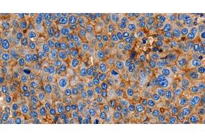Immunohistochemistry of paraffin-embedded Human esophagus cancer using Claudin 1 Polyclonal Antibody at dilution of 1:150