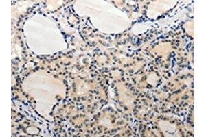 The image on the left is immunohistochemistry of paraffin-embedded Human thyroid cancer tissue using ABIN7189663(ADAMTS6 Antibody) at dilution 1/20, on the right is treated with synthetic peptide. (ADAMTS6 抗体)