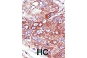 Formalin-fixed and paraffin-embedded human cancer tissue reacted with the primary antibody, which was peroxidase-conjugated to the secondary antibody, followed by DAB staining. (UBE2D1 抗体  (C-Term))