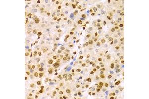 Immunohistochemistry of paraffin-embedded human liver cancer using DKC1 Antibody (ABIN5970956) at dilution of 1/100 (40x lens). (DKC1 抗体)