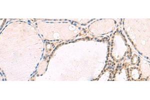 Immunohistochemistry of paraffin-embedded Human thyroid cancer tissue using RNF13 Polyclonal Antibody at dilution of 1:60(x200) (RNF13 抗体)