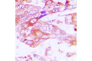 Immunohistochemical analysis of Cytochrome P450 2A13 staining in human lung cancer formalin fixed paraffin embedded tissue section.