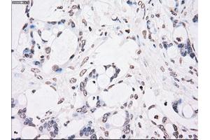 Immunohistochemical staining of paraffin-embedded Adenocarcinoma of colon tissue using anti-CHEK2mouse monoclonal antibody. (CHEK2 抗体)