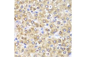 Immunohistochemistry of paraffin-embedded human liver cancer using SHMT2 Antibody.