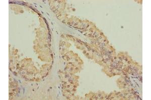 Immunohistochemistry of paraffin-embedded human prostate cancer using ABIN7147501 at dilution of 1:100 (CGGBP1 抗体  (AA 1-167))