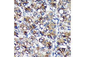 Immunohistochemistry of paraffin-embedded Human liver cancer using PYCR2 Rabbit pAb (ABIN7269766) at dilution of 1:100 (40x lens). (PYCR2 抗体  (AA 271-320))