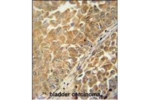 C antibody (Center) (ABIN654959 and ABIN2844598) immunohistochemistry analysis in formalin fixed and paraffin embedded human bladder carcinoma followed by peroxidase conjugation of the secondary antibody and DAB staining. (C18ORF25 抗体  (AA 163-191))