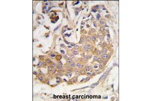 Formalin-fixed and paraffin-embedded human breast carcinoma tissue reacted with COL9A1 antibody , which was peroxidase-conjugated to the secondary antibody, followed by DAB staining. (COL9A1 抗体  (AA 428-456))