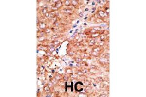 Formalin-fixed and paraffin-embedded human hepatocellular carcinoma tissue reacted with CCBP2 polyclonal antibody  , which was peroxidase-conjugated to the secondary antibody, followed by AEC staining. (CCBP2 抗体  (C-Term))