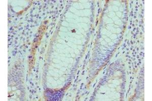 Immunohistochemistry of paraffin-embedded human colon cancer using ABIN7143460 at dilution of 1: 100 (ARFGAP1 抗体  (AA 1-220))