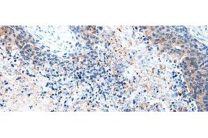 Immunohistochemistry of paraffin-embedded Human esophagus cancer tissue using COLEC12 Polyclonal Antibody at dilution 1:40