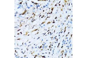 Immunohistochemistry of paraffin-embedded human gastric cancer using XRCC4 antibody (ABIN3022381, ABIN3022382, ABIN3022383 and ABIN6218772) at dilution of 1:100 (40x lens). (XRCC4 抗体  (AA 1-336))
