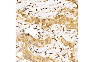 Immunohistochemistry of paraffin-embedded human breast cancer using GPS1 Rabbit pAb (ABIN6127934, ABIN6141361, ABIN6141362 and ABIN6222653) at dilution of 1:250 (40x lens). (GPS1 抗体  (AA 258-527))