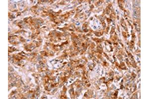 The image on the left is immunohistochemistry of paraffin-embedded Human prostate cancer tissue using ABIN7191308(LPCAT4 Antibody) at dilution 1/15, on the right is treated with synthetic peptide. (LPCAT4 抗体)