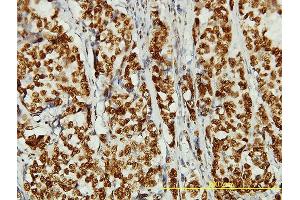 Immunoperoxidase of monoclonal antibody to KIAA0056 on formalin-fixed paraffin-embedded human breast cancer tissue. (NCAPD3 抗体  (AA 1-341))