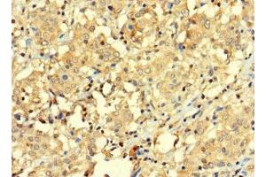 Immunohistochemistry of paraffin-embedded human lung cancer using ABIN7145137 at dilution of 1:100